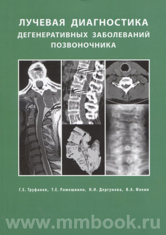 Лучевая диагностика дегенеративных заболеваний позвоночника