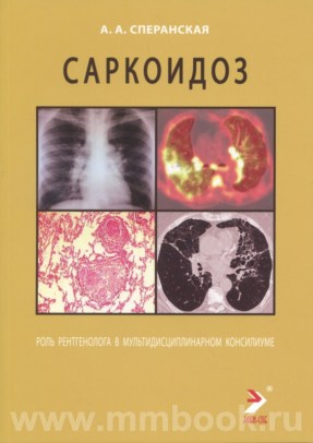 Саркоидоз. Роль ренгенолога в мультидисциплинарном консилиуме